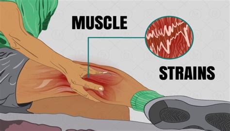 muscle tears away from bone